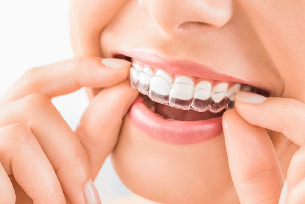 Reasons to Get Invisalign for Adults – Get the Smile You Love